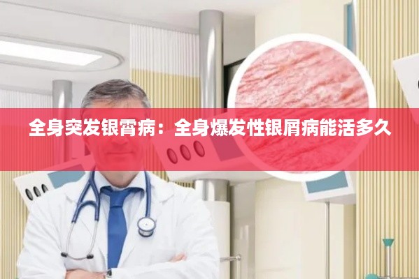 全身突发银霄病：全身爆发性银屑病能活多久 