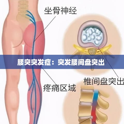 腰突突发症：突发腰间盘突出 