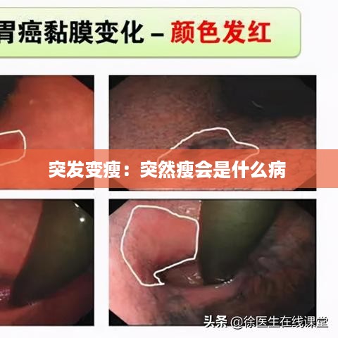 突发变瘦：突然瘦会是什么病 