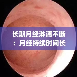 长期月经淋漓不断：月经持续时间长淋漓不尽 