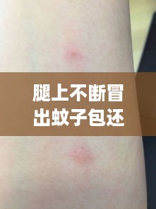 腿上不断冒出蚊子包还痒：腿上都是蚊子包怎么回事 