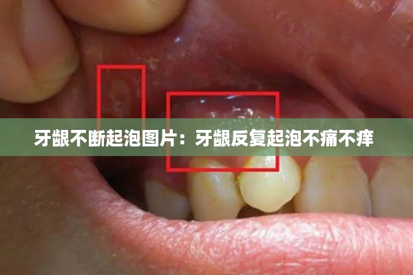 牙龈不断起泡图片：牙龈反复起泡不痛不痒 