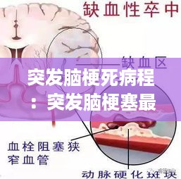 突发脑梗死病程：突发脑梗塞最佳抢救时间 