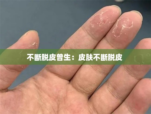 不断脱皮曾生：皮肤不断脱皮 