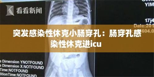 突发感染性休克小肠穿孔：肠穿孔感染性休克进icu 